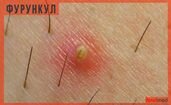 Фурункул или карбункул: как отличить