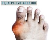 Подагра на ногах: причины, симптомы, лечение