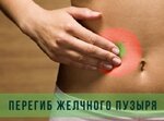 Перегиб желчного пузыря